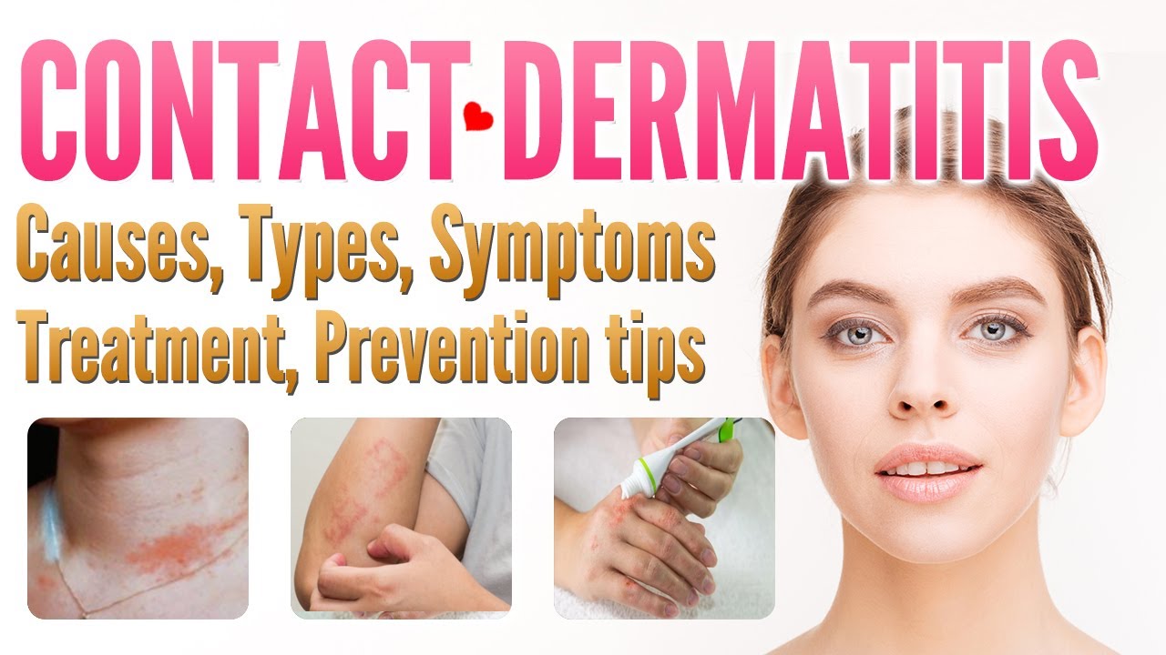 Contact Dermatitis Causes, Types, Symptoms, Treatment, Prevention ...