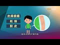 【杏林在線】濕疹的煎熬