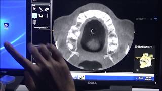 Guidance on pterygoid implant placemement with CBCT