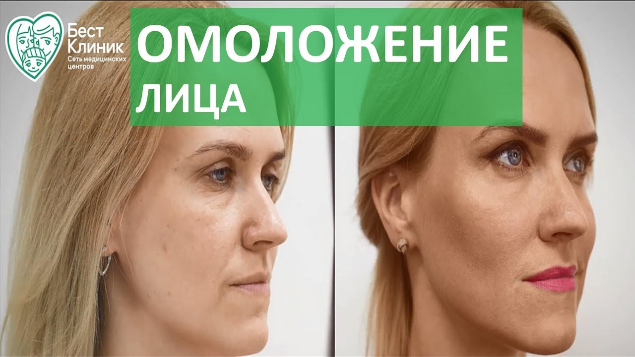 Возрастные изменения лица. 👩 Комплексный подход в борьбе с возрастными изменениями лица.