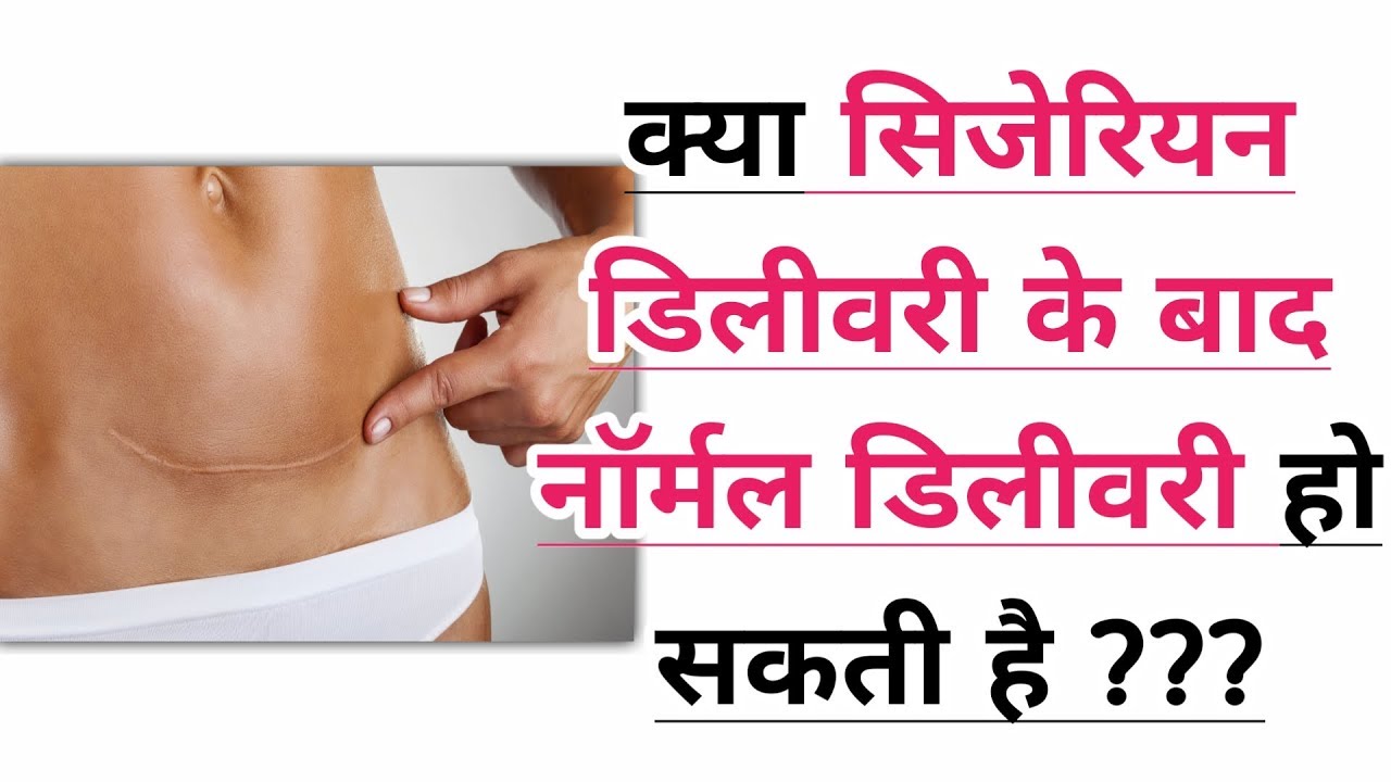 क्या सिजेरियन डिलीवरी के बाद नार्मल डिलीवरी हो सकती है  Normal Delivery after cesarean / c section