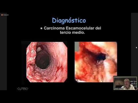 Vídeo: Tasa De Supervivencia Del Cáncer De Esófago: Cinco Años, Relativo Y Más