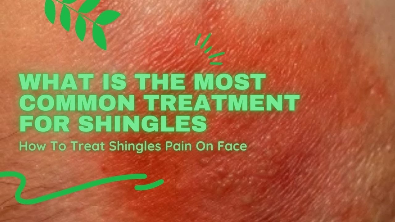 What Is The Most Common Treatment For Shingles How To Treat Shingles