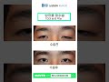 #남자짝눈 #10대짝눈 #쌍꺼풀재수술 #눈수술전후 #짝눈수술 #눈수술전후 #비아이오성형외과 비아이오성형외과 #홍성표원장