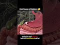 Real Causes of Gallstones 🪨 | Why Do Gallstones Actually Form?