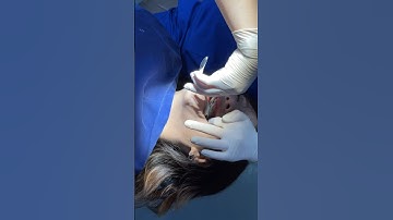 Âm thanh mà người niềng răng nào cũng muốn nghe 🥹🥹 #niengrang