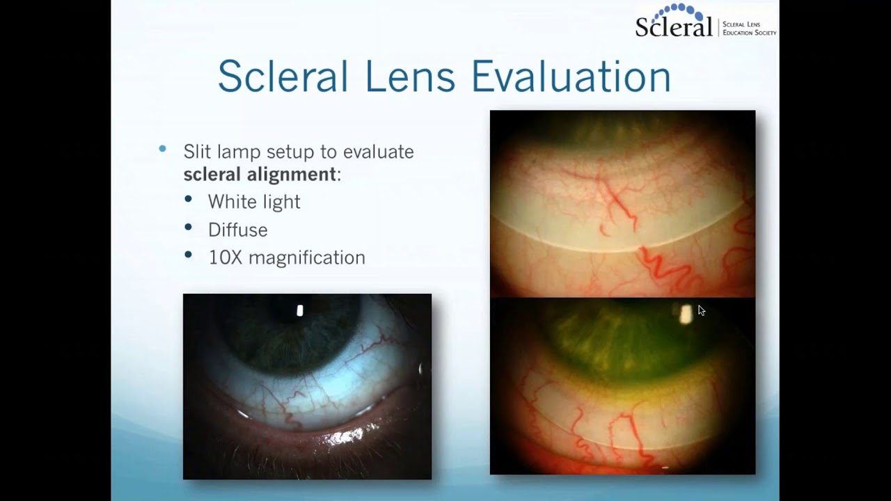 Scleral Lenses Basic to Advanced Troubleshooting YouTube
