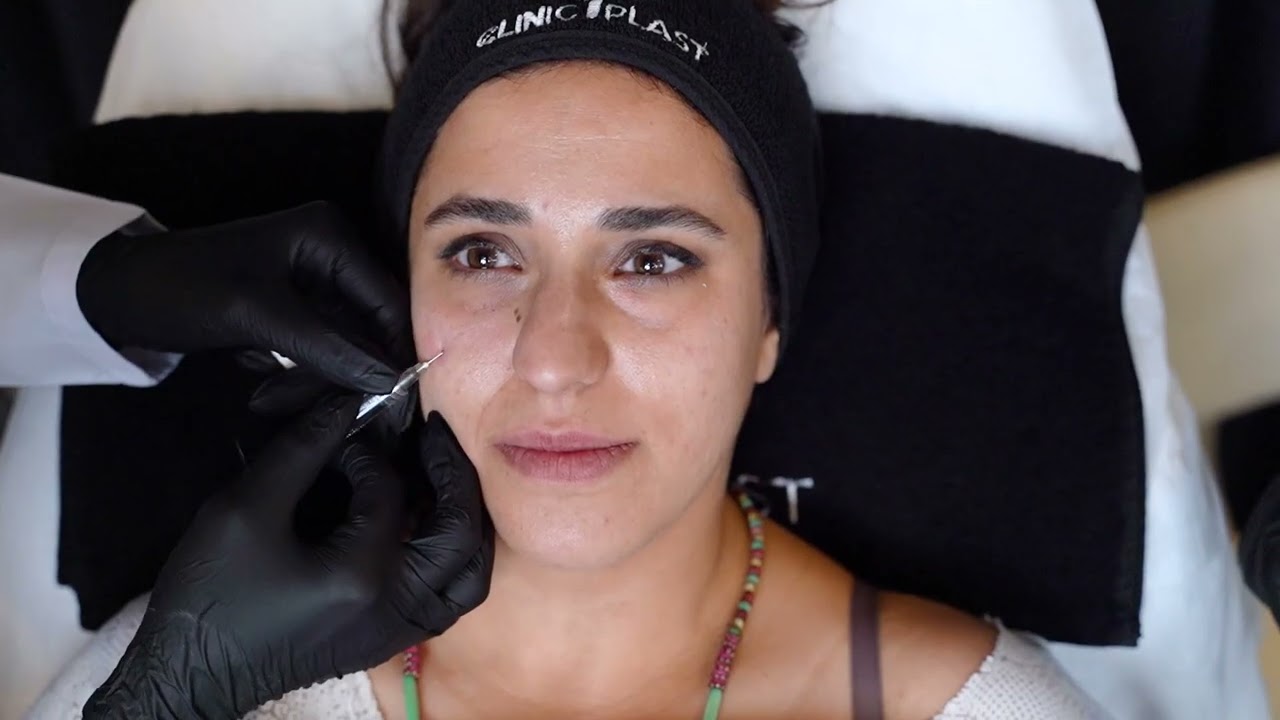 Göz Altı Işık Dolgusu ile Yenilenme Zamanı - Göz Altı Işık Dolgusu Nasıl Yapılır?