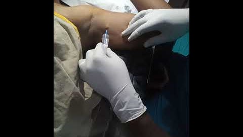 Intercostobrachial nerve block