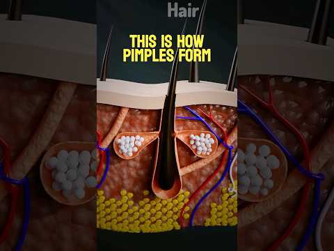 “How Pimples Form”?