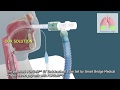 The patented POPSafe™ ET Endotracheal Tube Set by Smart Bridge Medical - 3D Medical Animation