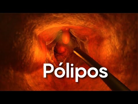 Pólipos - Gastrobene