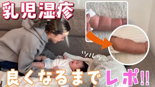 酷い乳児湿疹が出てから〜良くなるまでをレポ。（4ヶ月赤ちゃんの成長記録