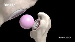 MiniHip™ - Surgical Technique (MKII Instrumentation)