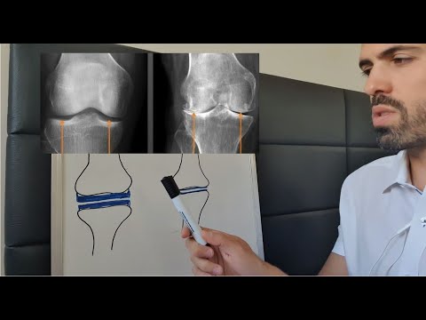 Vídeo: Redução Do Espaço Articular: Causas, Tratamento E Muito Mais