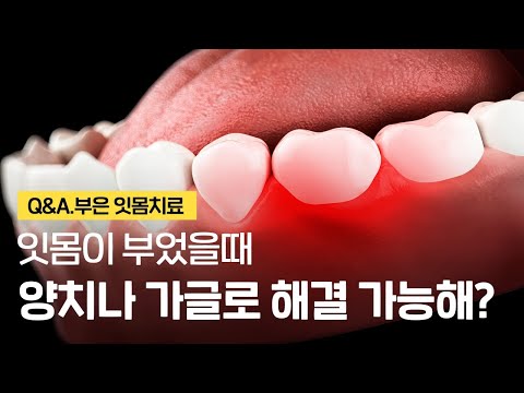 잇몸 부었을때 양치 가글 효과는? (부은잇몸 원인 치료 대처법)