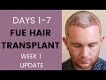 FUE Hair Transplant Week 1 | Recovery, healing, sleeping, itching, swelling, travelling