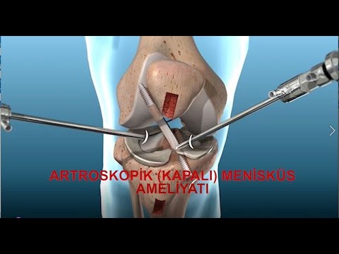 Artroskopik (Kapalı) Menisküs Ameliyatı Op. Dr. İlker Özden