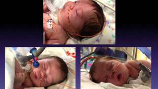 The Beginning Video Campomelic Dysplasia