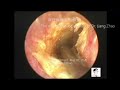 Endoscopic ear treatments by Dr Zhao EP. 8 - 02/03/2020