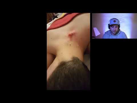 huge cyst eruption on the neck of this man !