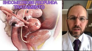 ENDOMETRIOSE PROFUNDA - TRATAMENTO