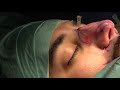 Hump Excision/ Osteotomies and Naison Graft: Nose Reshaping Bizrah Rhinoplasty