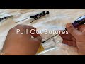 Perclose closure device - how does it work & how to deploy.