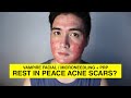 RIP Acne Scars? - My First Microneedling + PRP experience | Envi Beauty [PART 1]