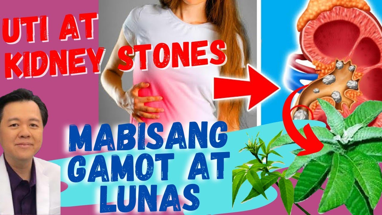 ⁣Kidney Stones at UTI: Mabisang Gamot at Lunas - Payo ni Doc Willie Ong