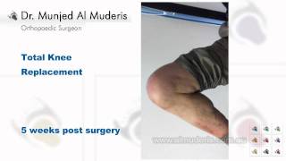 Total Knee Replacement - 5 weeks post surgery