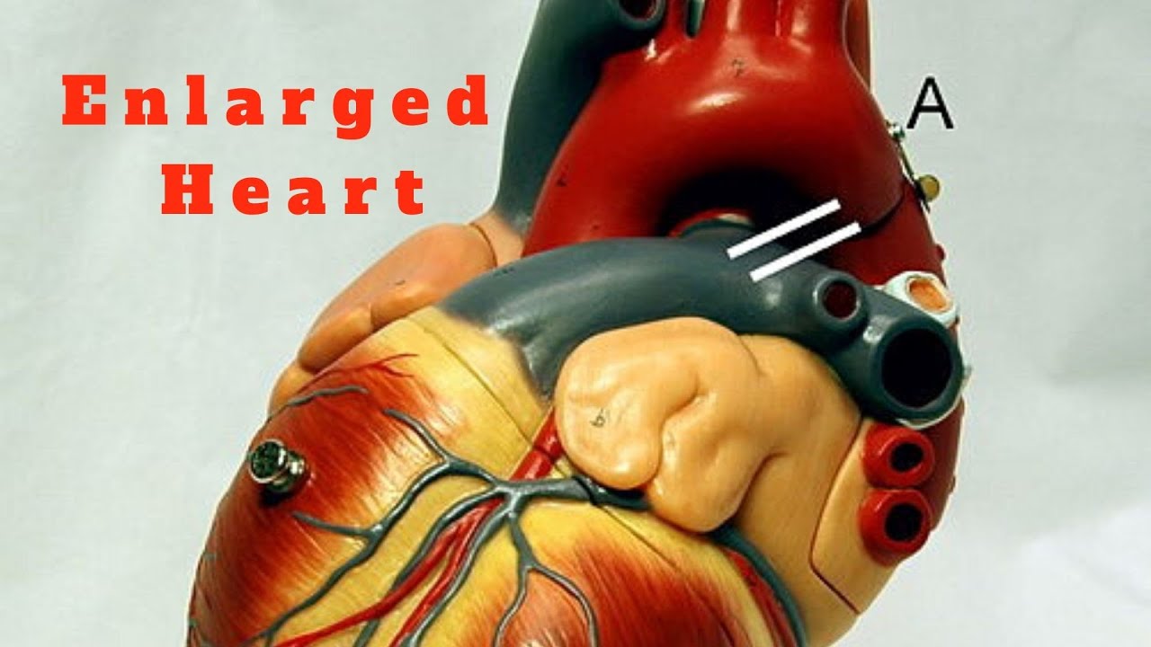 Enlarged Heart- Prevention and Treatment