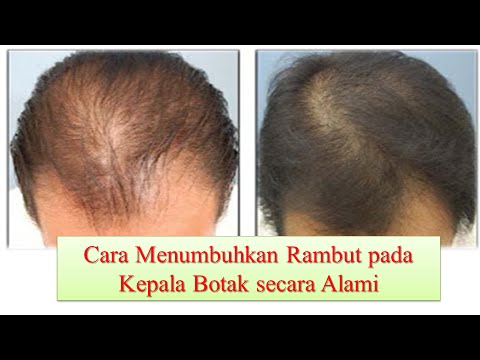  Cara  Menumbuhkan Rambut  di Kepala Botak Secara Alami  YouTube