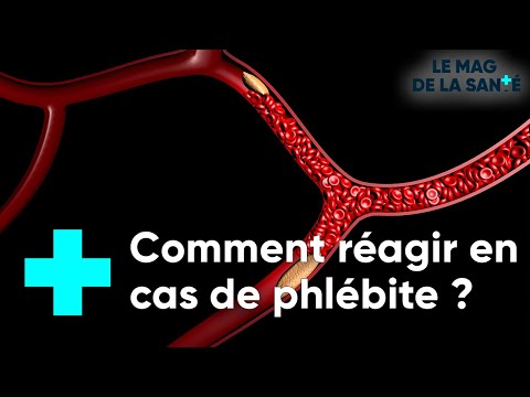 Vidéo: Qu'est-ce que la phlébite oblitérante ?