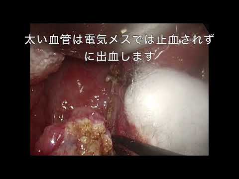 扁桃腺の手術