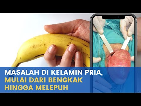 Video: Kista Testis Pada Lelaki: Gejala Dan Rawatan, Akibatnya, Diagnosis