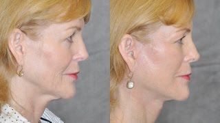 AuraLyft Mini Facelift Mini Lift Wide Awake Face & Neck Rejuvenation No Scars Bevelry Hills