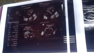 Sunmory Bersama Bumil Sambil Cek Usg Si Baby Boy