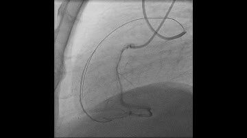 LAD CTO Case 5 , wire de-escalation.