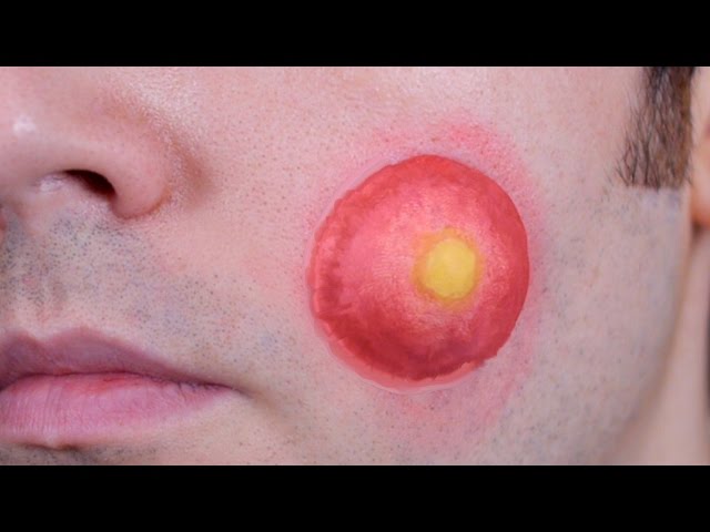 Biggest Zit In The World