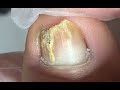 Cracked nail repair