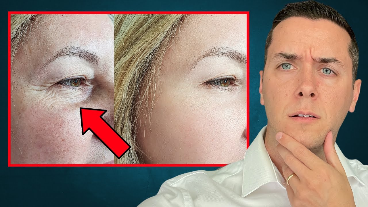 9 EASY Ways to Get Rid of Under Eye Wrinkles - YouTube