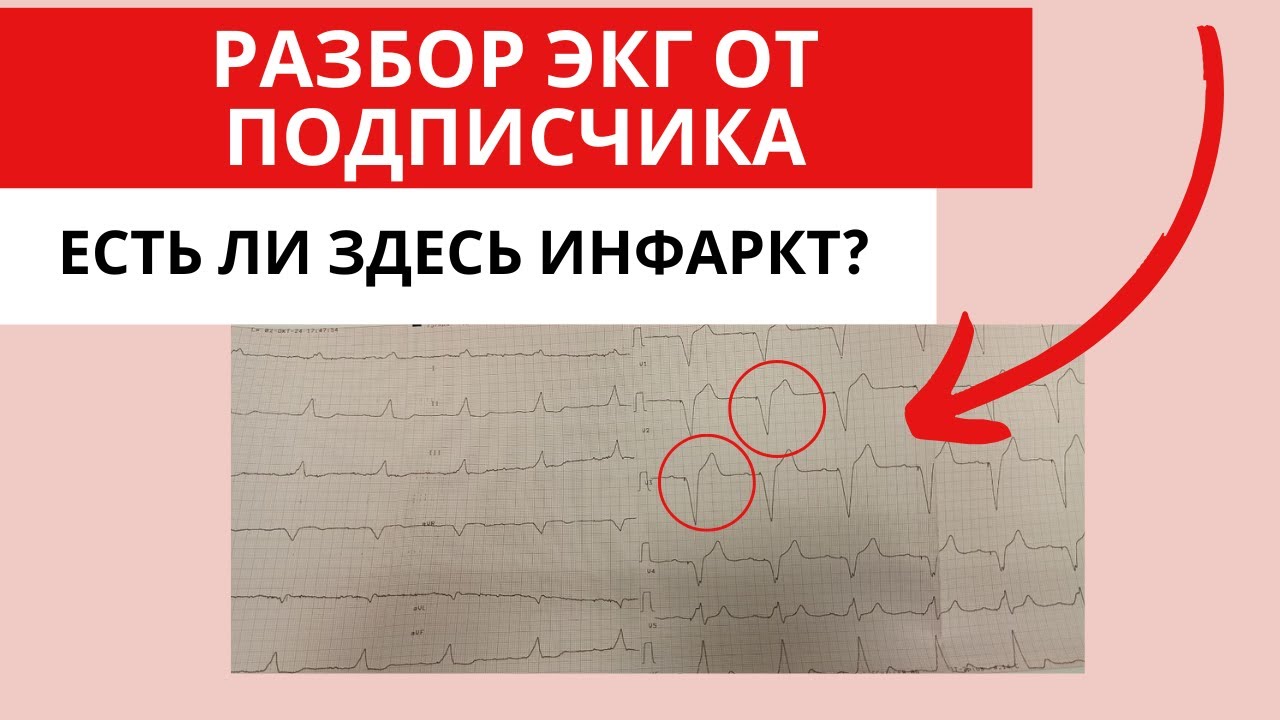 Разбор ЭКГ от подписчика. Можно ли увидеть инфаркт при кардиостимуляторе?