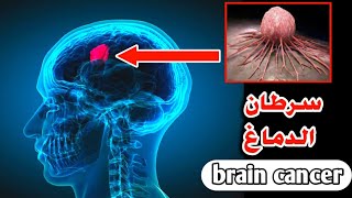 شاهد كيف يتم ازالة سرطان الدماغ بالجراحة_Watch How Brain cancer Are Removed