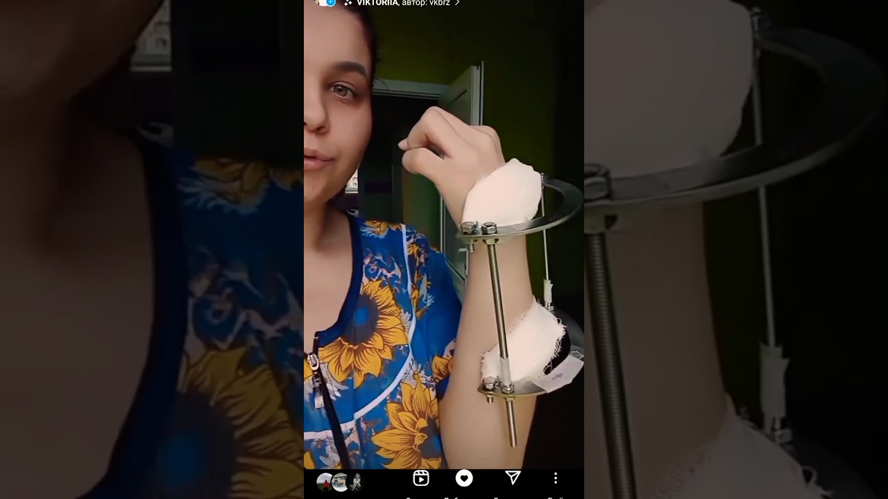 аппарат Илизарова
