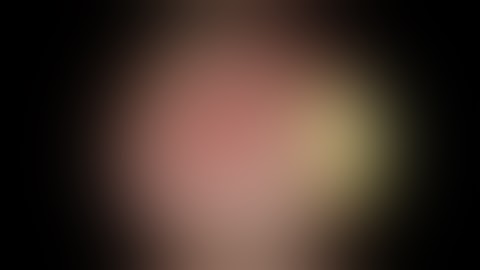 Bladder cancer Surgery/TURBT ( Trans Urethral Resection of Bladder Tumor)