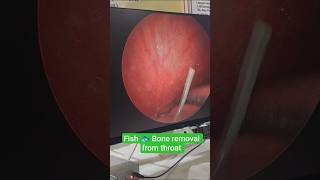 Fish Bone Removal From Throat Via 70 Degree Throat Endoscopy