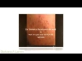Sebaceous Cyst Removal 100 CURE Naturally Barbara A Lamm Sebaceous Cyst Removal 100 CURE Naturally Barbara A Lamm