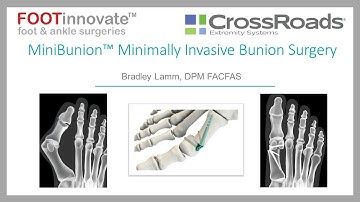 Crossroads Extremity Systems: MiniBunion™ Minimally Invasive Bunion Surgery with Bradley Lamm, DPM