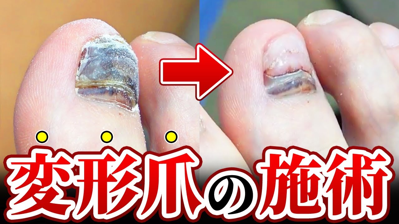 深爪チャンネルちゃん 施術動画】長年諦めていた真っ黒で分厚くなった爪をきれいに！変形爪